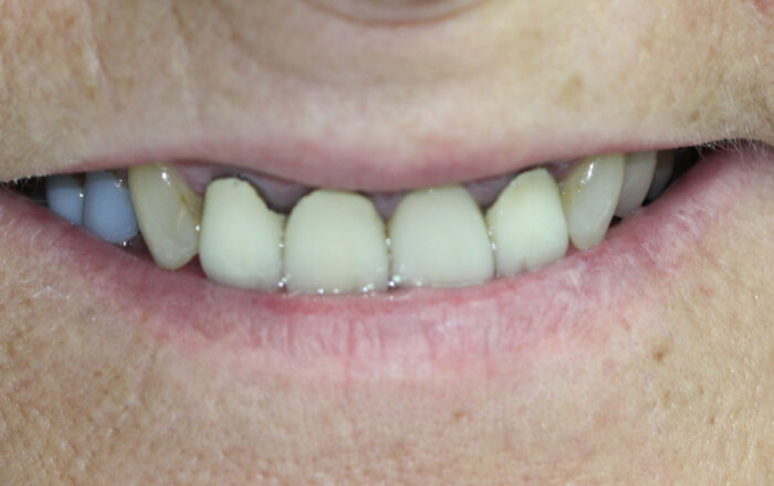 Before - Denpure Dental