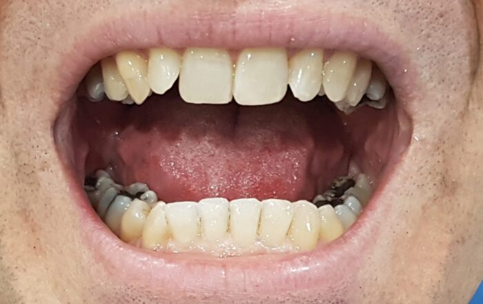 After - Denpure Dental