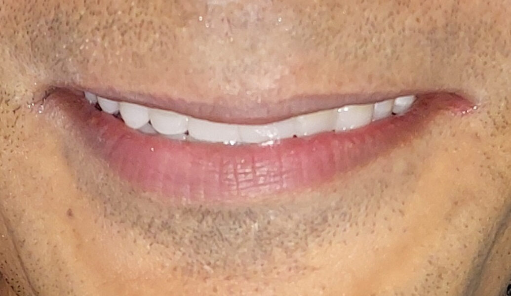 After - Denpure Dental