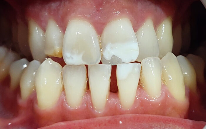 Before - Denpure Dental