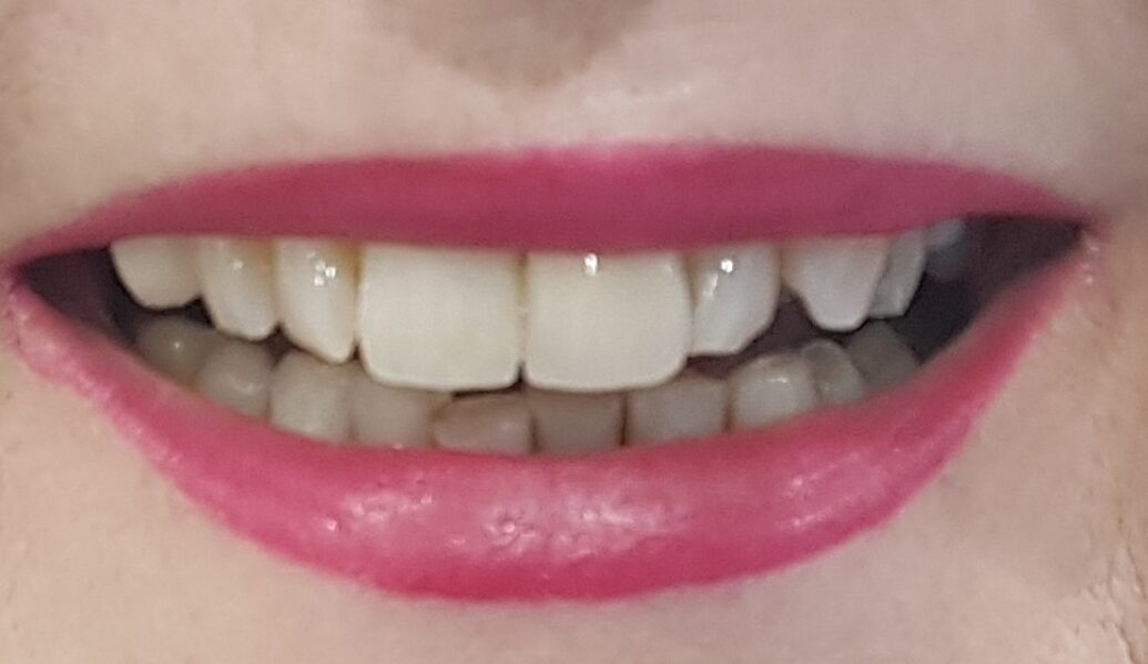 After - Denpure Dental