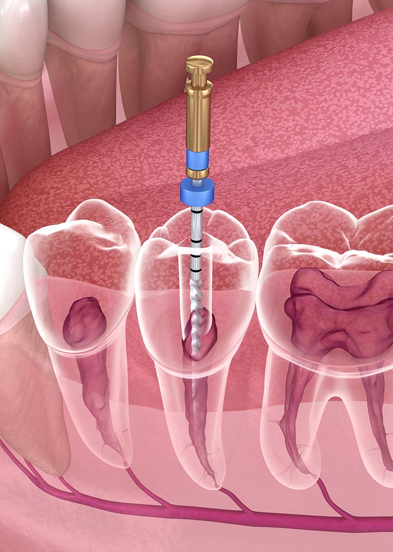 Treatment - Denpure Dental